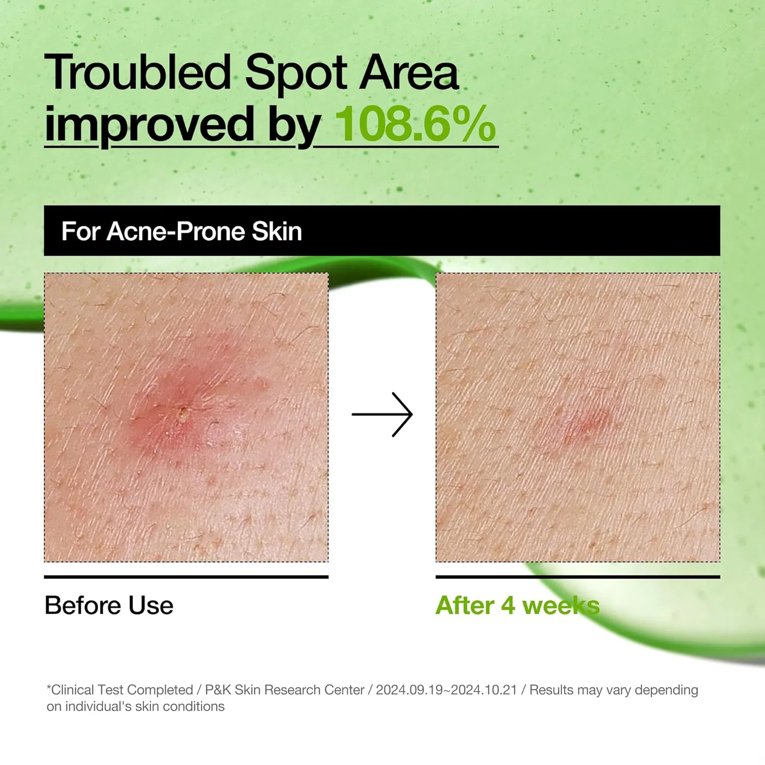 Anua Azelaic Acid 10+ Hyaluron Redness Soothing Serum – 30ml - Image 5