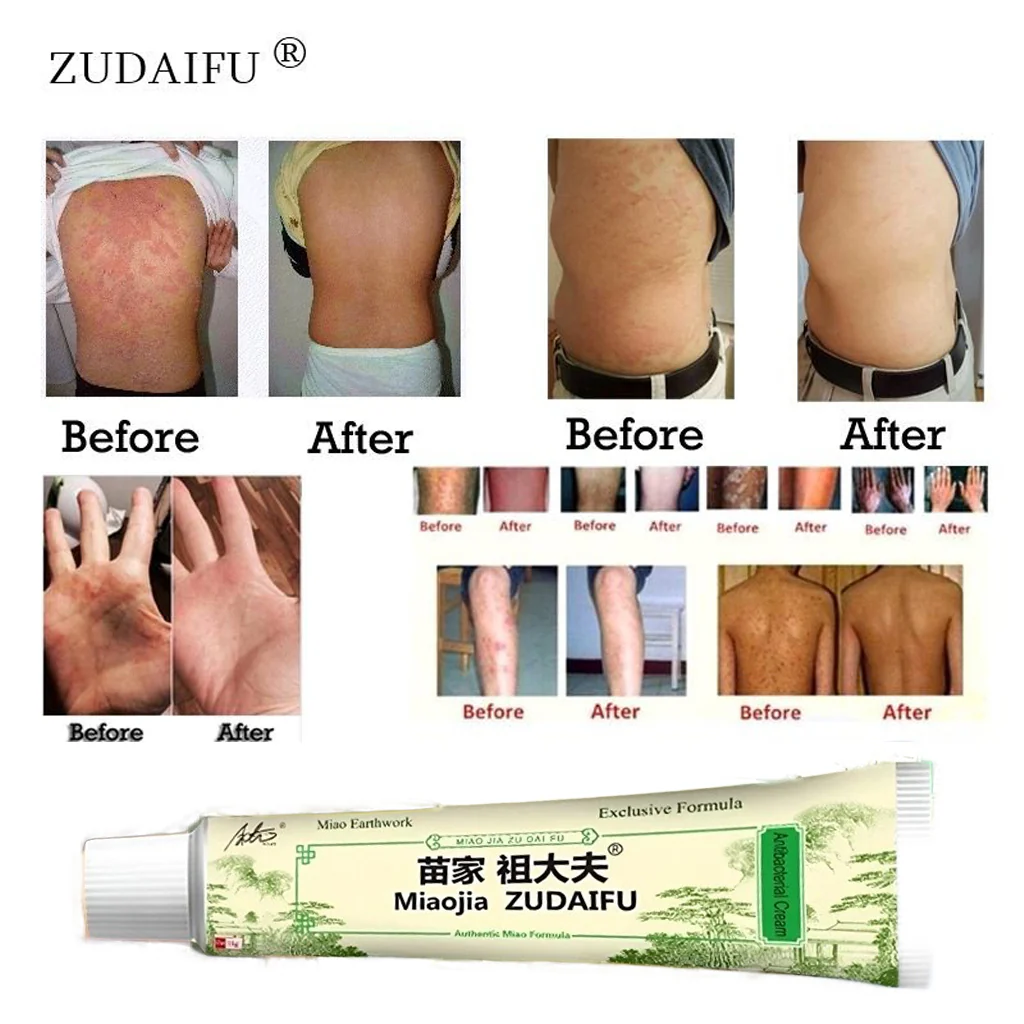 Miaojia Zudaifu Antibacterial Cream – Authentic Miao Formula (15g) - Image 7