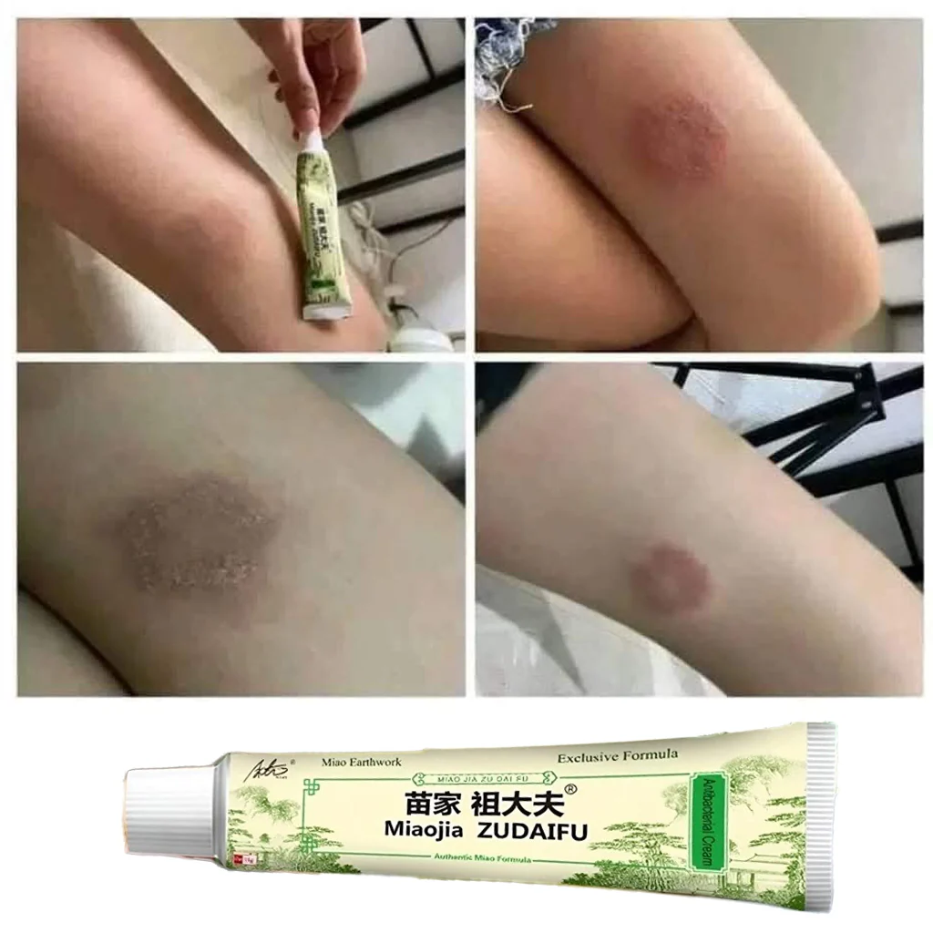 Miaojia Zudaifu Antibacterial Cream – Authentic Miao Formula (15g) - Image 9
