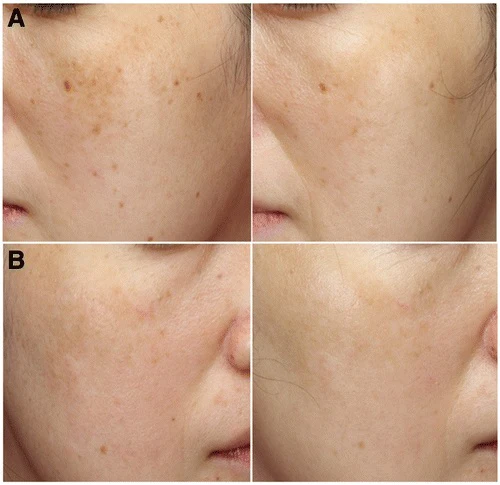 Vivi Gold 24k Melasma Serum - 100ml - Image 3
